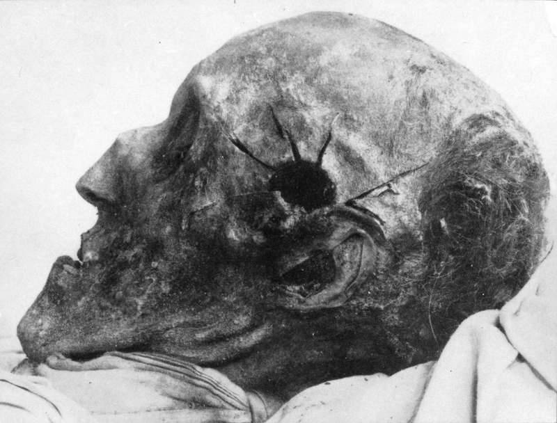 Karl XII's skull (from opening of the grave in 1917)